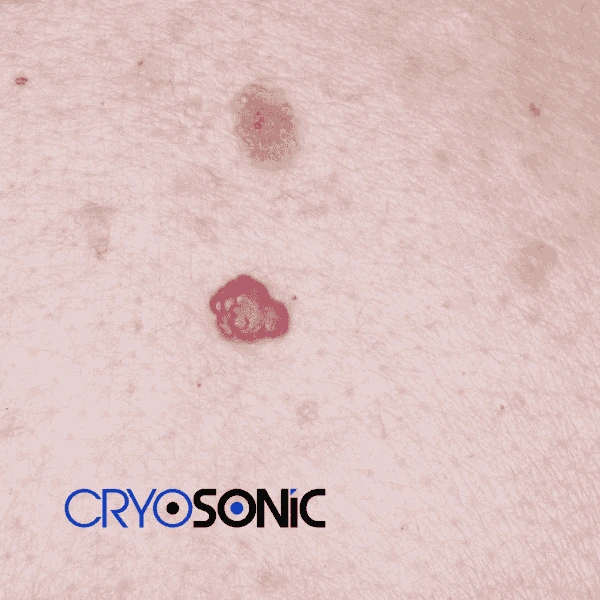 Looking for pain free cherry angioma removal treatment Stockport? Call our team today! Stockport