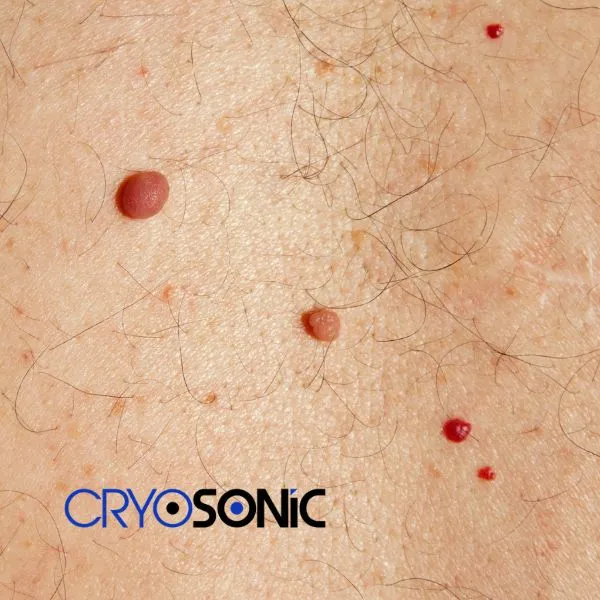 get cherry angioma removal treatment today! Stockport