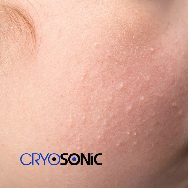 Are you looking for milia removal treatment? Contact our team today Stockport