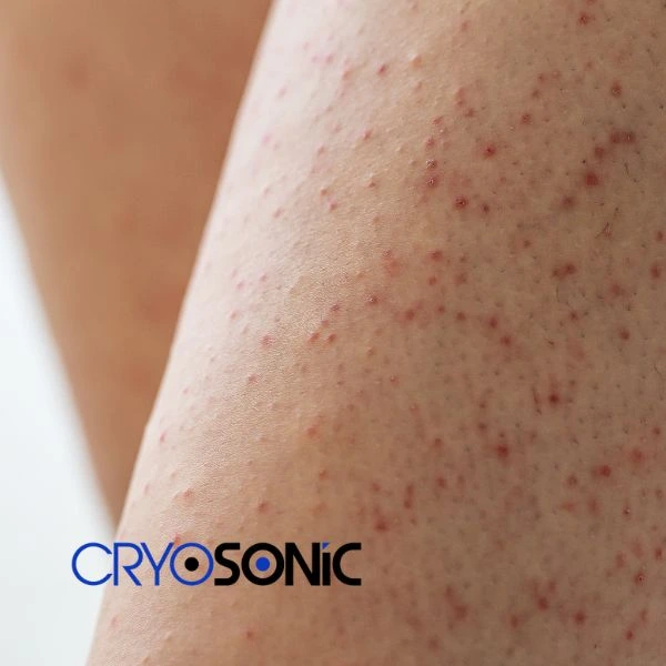 Looking for Seborrhoeic Keratosis removal Stockport treatment? Call our consultants today in Stockport