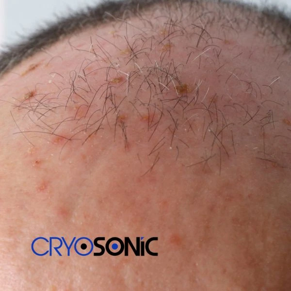 Access Seborrhoeic Keratosis removal from the comfort of your own home! Call us today in Stockport