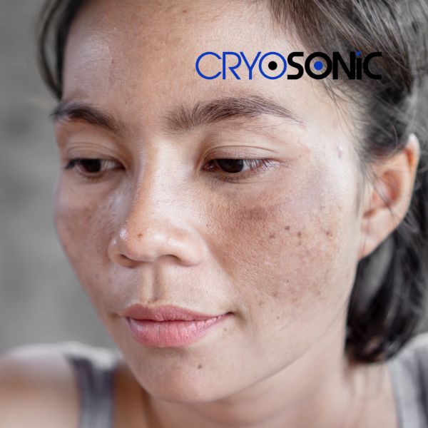 Ready to start age spots removal? Contact our team today in Stockport
