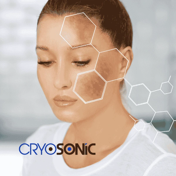Are you looking for age spot removal treatment? Contact Cryosonic today in Stockport
