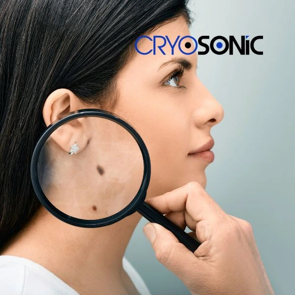 Do you want to learn more about benign moles removal treatment? Call our team today Stockport