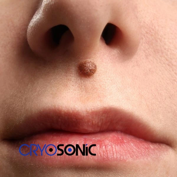 Start your benign moles removal treatment today Stockport
