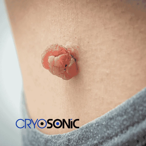 Book your skin tags removal Stockport from comfort of your own home! Stockport