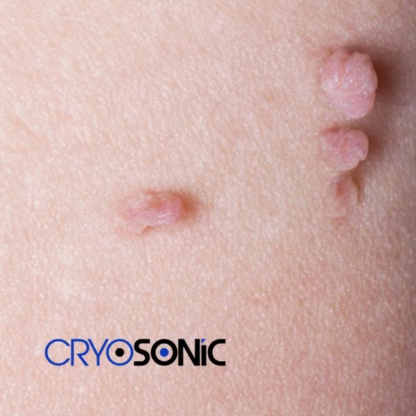 Are you looking for fast effect skin tag removal Stockport? Book in NOW! Stockport
