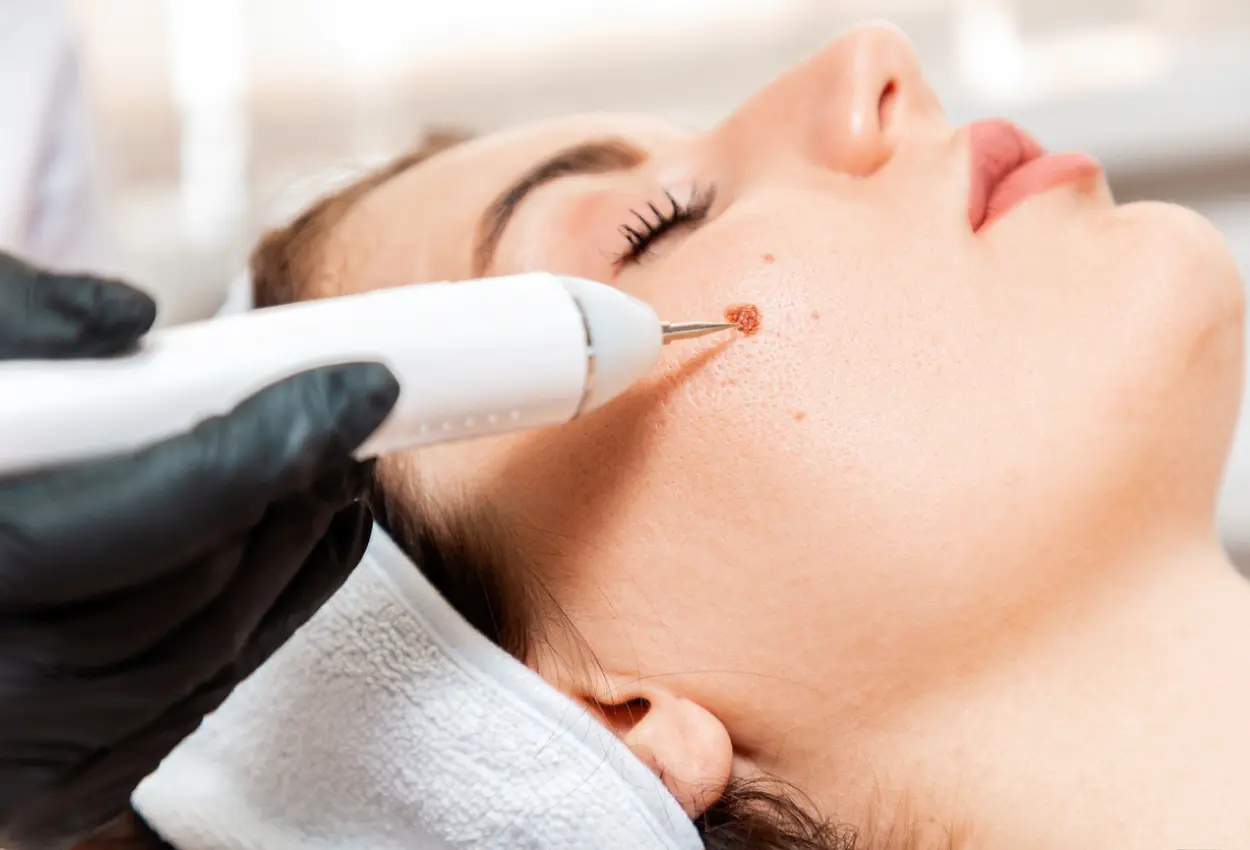 Frequently Asked Questions About Multiple Cryotherapy Treatments Stockport