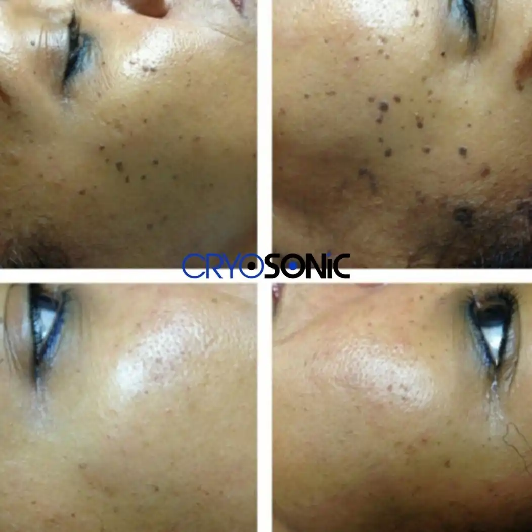 Why Skin Shows Pigmentation After Treatment Stockport